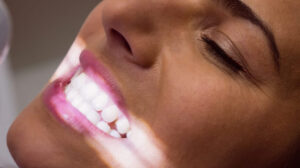 Czy domowe sposoby wybielania zębów są skuteczne? Wybielanie zębow